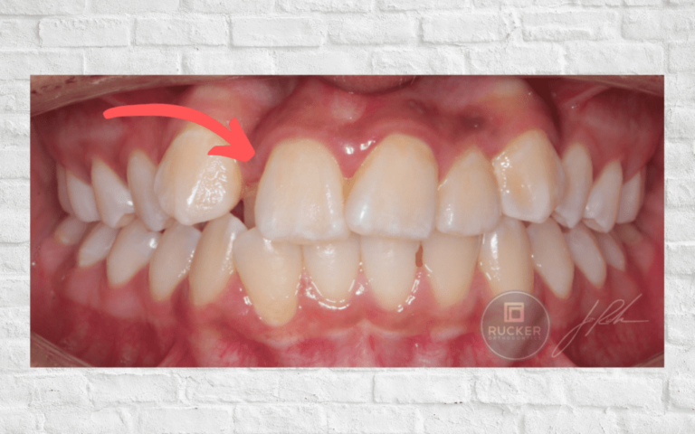 Orthodontics Case of Anterior Crossbite - Rucker Orthodontics