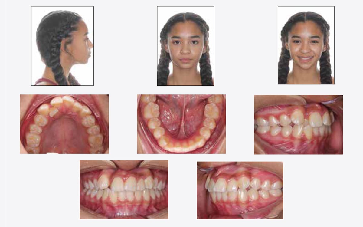 Braces – Non-extraction Straightwire Technique - Non-Extraction