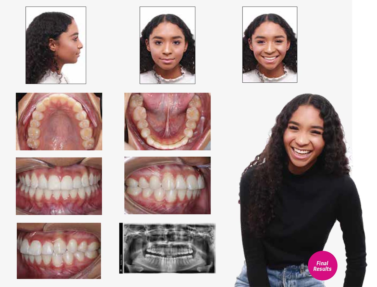 Braces – Non-extraction Straightwire Technique - Non-Extraction Orthodontics