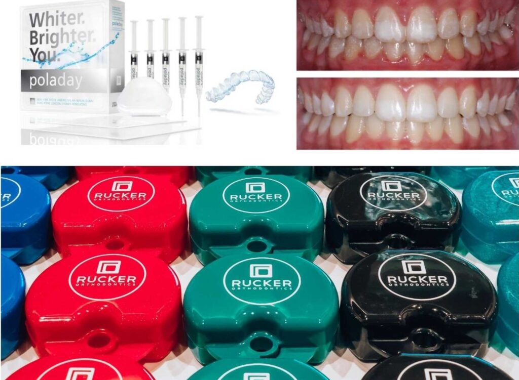 Lifetime Retainers + Whitening - Rucker Orthodontics