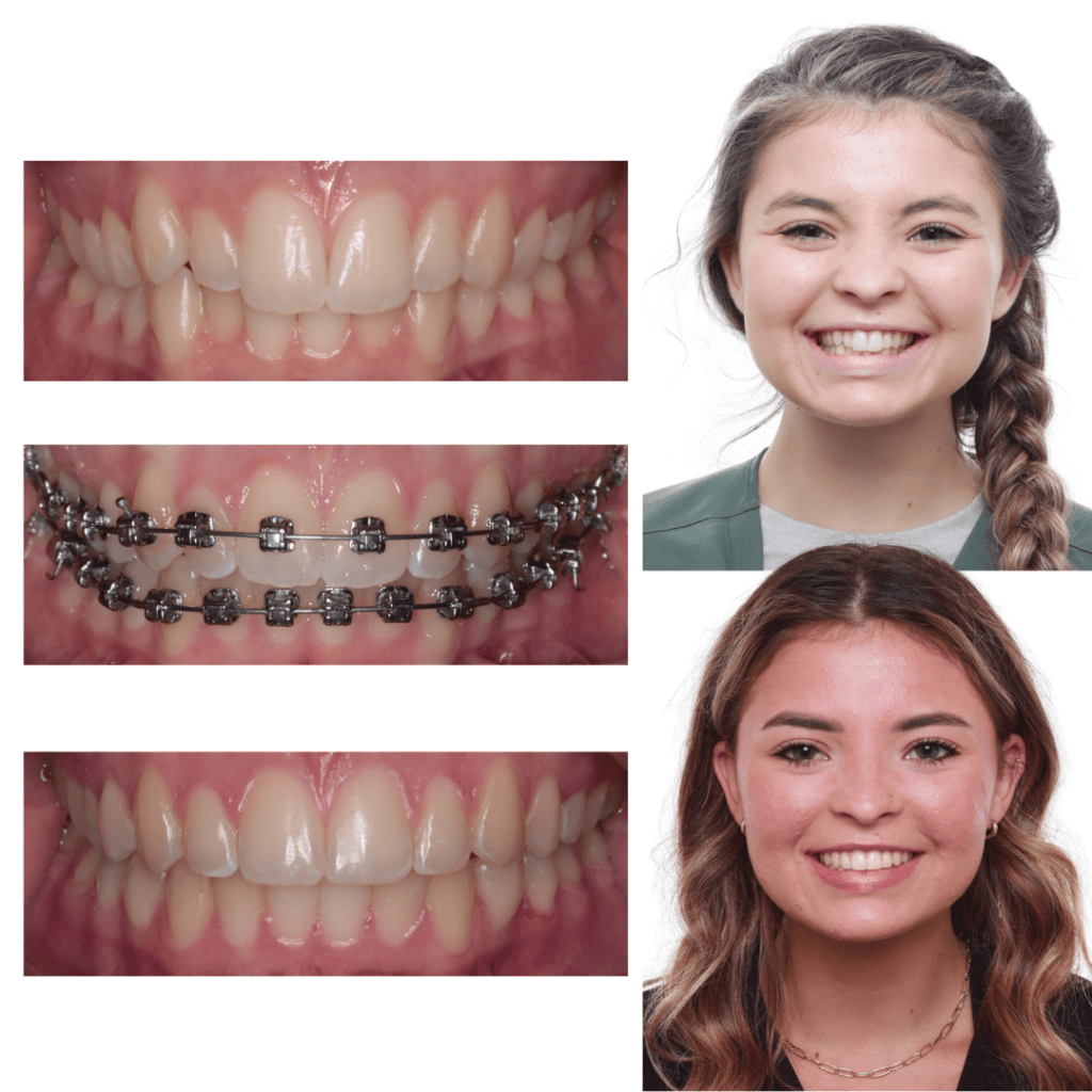 Braces treatment progression | Rucker Orthodontics Patient example showing teeth before braces, during braces treatment, and after treatment, alongside smile portraits.